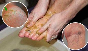 En sólo minutos desaparecerán las várices, los callos y pies agrietados con este remedio caseroâ?¦