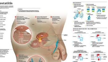 Remedios para prostatitis bacteriana aguda y crónica