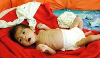 Latinoamérica afectada por una desnutrición crónica 