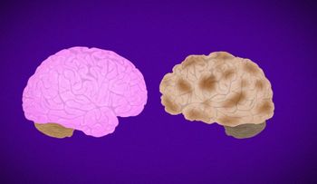 No, el Alzheimer no es contagioso