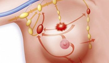 Identifican un gen â??esencialâ? en la resistencia de un cáncer de mama agresivo