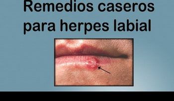 Como frenar un herpes labial con este sencillo truco (VIDEO)