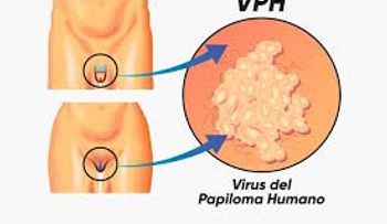 El virus del Papiloma humano y los beneficios de la vacuna; descubre todo sobre esta enfermedad