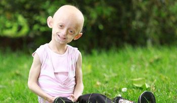Progeria: Rara enfermedad que acelera el envejecimiento