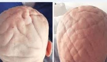 Un hombre va al médico por su cabeza con forma de cerebro; sufre de acromegalia