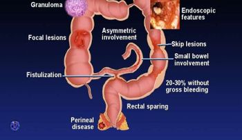 Todo lo que debe saber sobre la enfermedad de Crohn