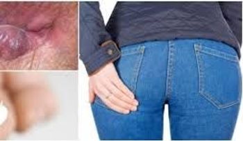 Las terribles hemorroides y cómo tratar esta enfermedad