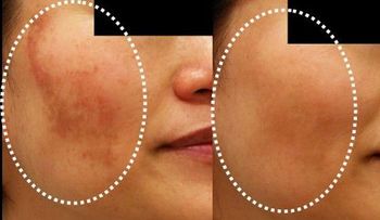 Nuevo tratamiento para el melasma (Manchas en el rostro)