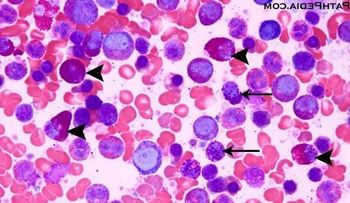 Mielofibrosis: enfermedad detectada en la tercera edad