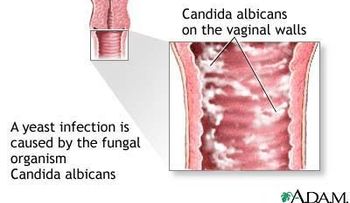 Como curar hongos vaginales con betedine vaginal