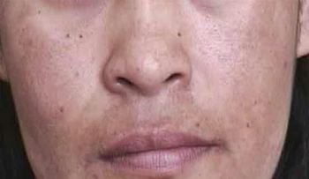 Cómo eliminar las manchas de la cara