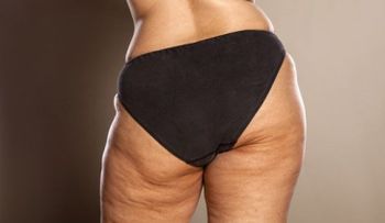7 rituales matutinos para eliminar la celulitis