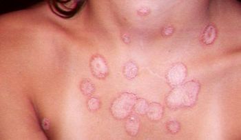 Bicarbonato con vinagre, agua tibia y jengibre para los hongos en la piel