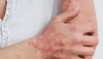 República Dominicana en alerta por peligrosa infección cutánea reportada en Haití