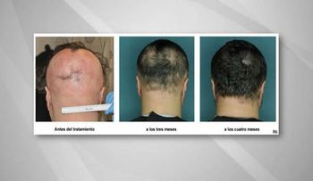 Medicamento revierte pérdida del cabello en un tipo de alopecia