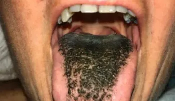 El "síndrome de lengua peluda negra" se produce por acumulación de células muertas en la piel