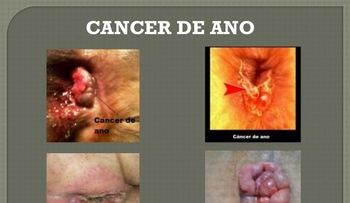 ¿Cómo se realiza el diagnóstico del cáncer de ano?
