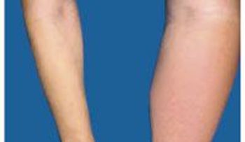 Acumulación de líquido o linfedema