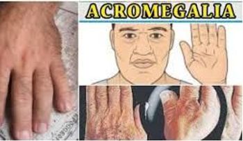 Acromegalia: enfermedad crónica que hace crecer manos, pies y rostro