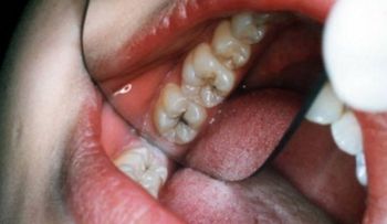 El aceite de coco tiene un poder increíble para eliminar las caries de forma natural