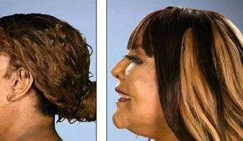 Una mujer se inyectó cemento en la cara; mira ahora su transformación 
