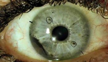 El extraño tipo de cáncer de ojo que tiene desconcertados a los expertos