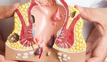 El cáncer del ano puede ser letal y muchos no lo saben: JAMÁS LO HUBIERA IMAGINADO