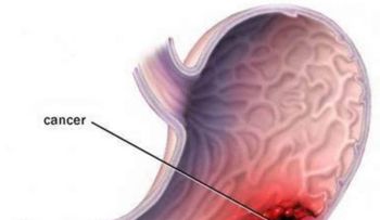 El cáncer de estómago: una enfermedad silenciosa: Sabes cuáles son los síntomas?