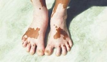 El vitiligo: Una enfermedad que no puede prevenirse, pero pararse; afecta entre el 1 y el 2 por ciento población mundial