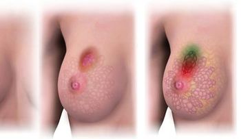 ¿Sabías que cuatro de cada diez tumores se pueden prevenir?