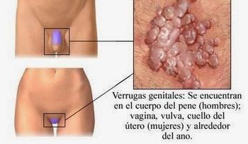 La gonorrea puede ser peligrosa para hombres y mujeres