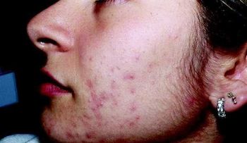 Qué es hirsutismo: definición y concepto, causas y tratamiento