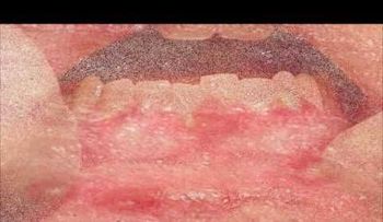 Como eliminar Herpes. Remedios Naturales