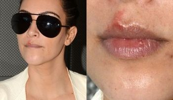 Kim Kardashian tiene herpes, y si tu tienes menos de 50 años, también puedes tenerlos 