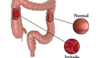 Dieta para el síndrome del intestino irritable: más común en mujeres, que hombres