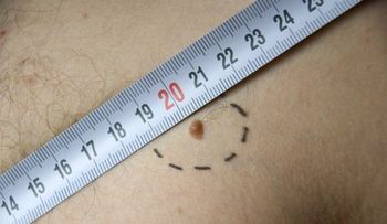 10 cosas que no sabías sobre el melanoma.