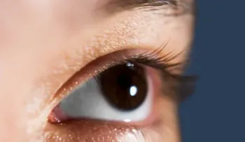 Cuidado con el glaucoma si tienes miopía