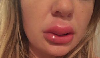 Jessica Bennett, compartió un video mostrando pus de sus labios infectados por un relleno â??baratoâ??