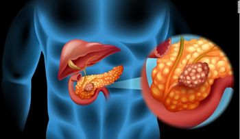 La diabetes después de los 50 podría ser un signo temprano de cáncer de páncreas