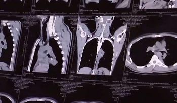 Tenía 20 años con ataques de tos, lo operaron y descubrieron un insólito objeto en sus pulmones