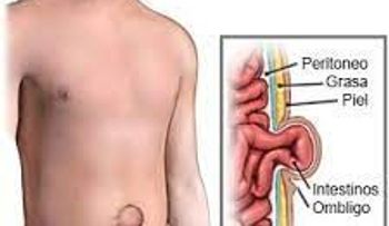 Tratamiento natural para la hernia umbilical