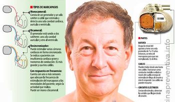 El marcapasos va rumbo a su fin