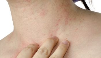 ¿Qué es la alergia a los antibióticos?