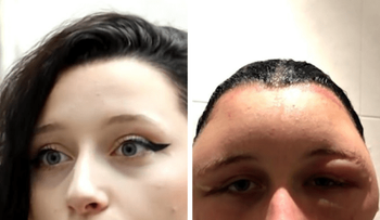 Tinte de pelo le infló la cabeza y casi la mata