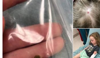 Niña sufre parálisis luego de recibir una picadura de garrapata en la cabeza