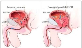 Testimonio: curar cáncer de próstada de forma natural 