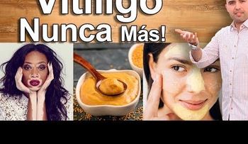Remedios caseros para el vitiligo