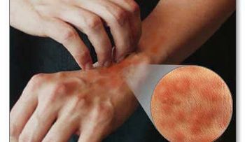 Síntomas de la alergia al látex