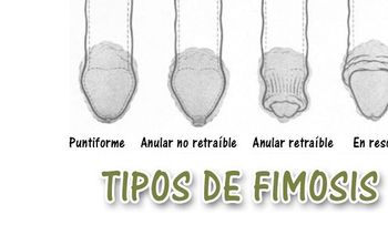 La fimosis, una enfermedad común en el pene del hombre; cómo detectarla