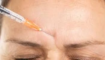 Botox: ¿Qué es, cómo funciona y cuáles son sus mitos y verdades?